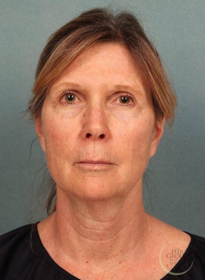 Facelift Before & After Patient #9193