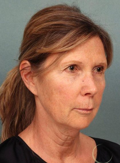 Facelift Before & After Patient #9193