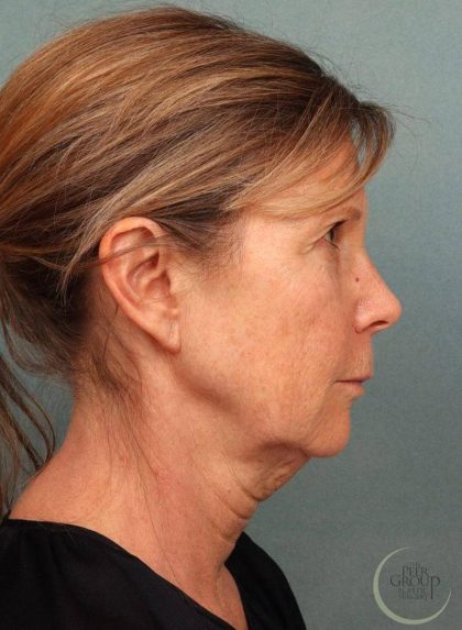 Facelift Before & After Patient #9193