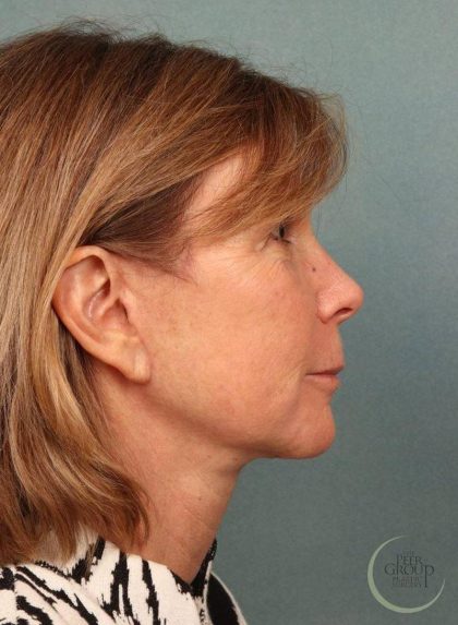 Facelift Before & After Patient #9193