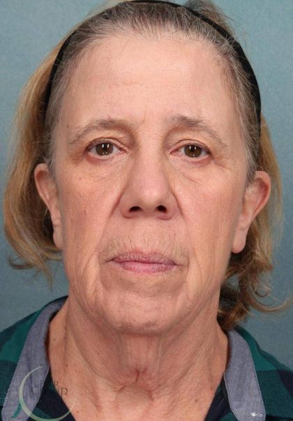 Facelift Before & After Patient #9194
