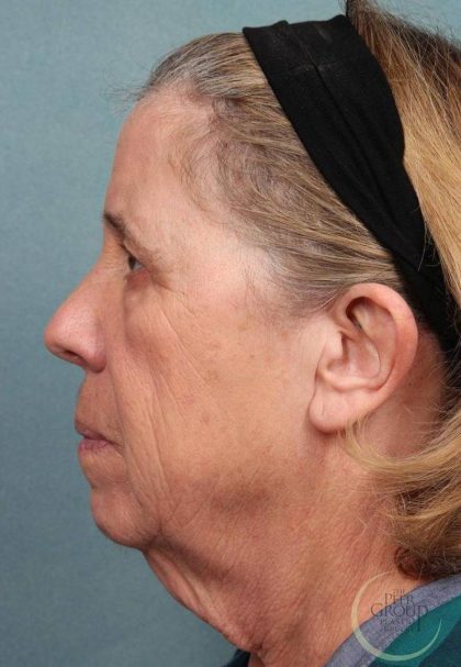 Facelift Before & After Patient #9194