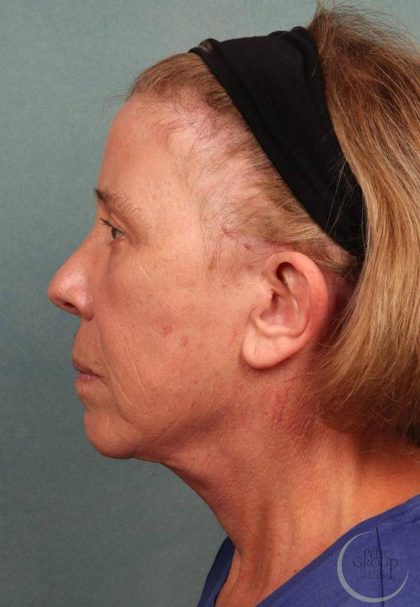 Facelift Before & After Patient #9194