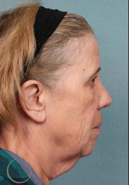 Facelift Before & After Patient #9194
