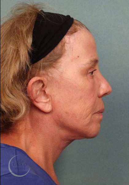 Facelift Before & After Patient #9194