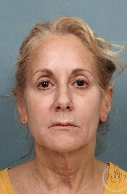 Facelift Before & After Patient #9195