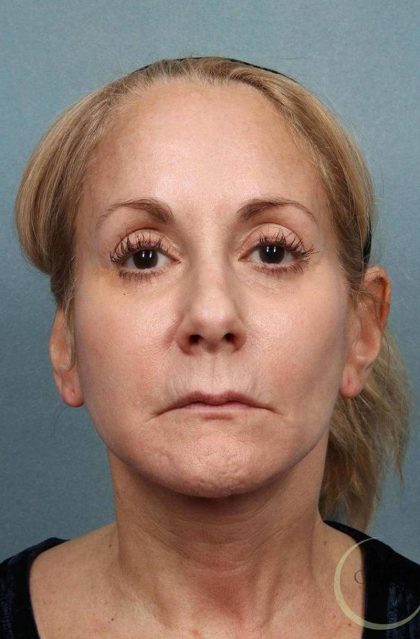Facelift Before & After Patient #9195