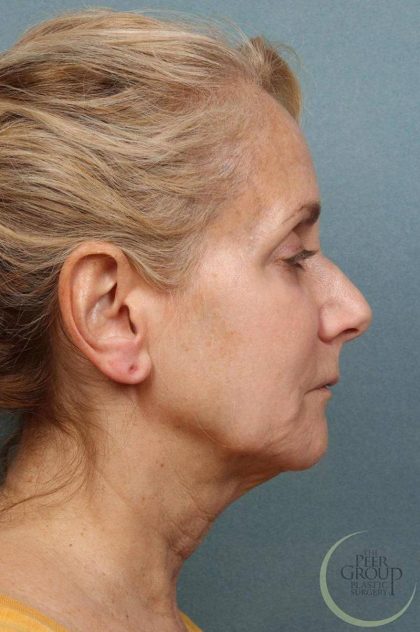 Facelift Before & After Patient #9195