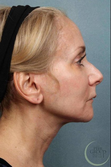 Facelift Before & After Patient #9195