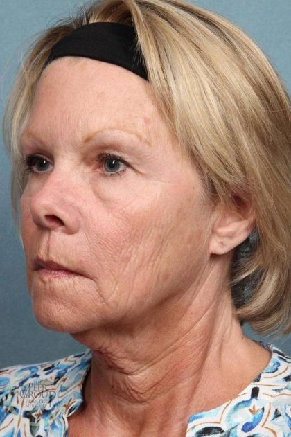Facelift Before & After Patient #9196