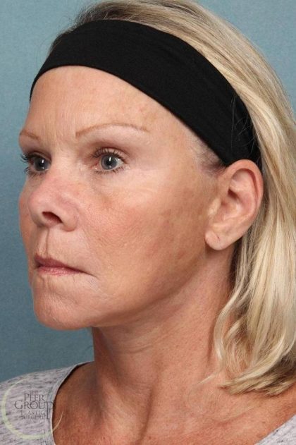 Facelift Before & After Patient #9196