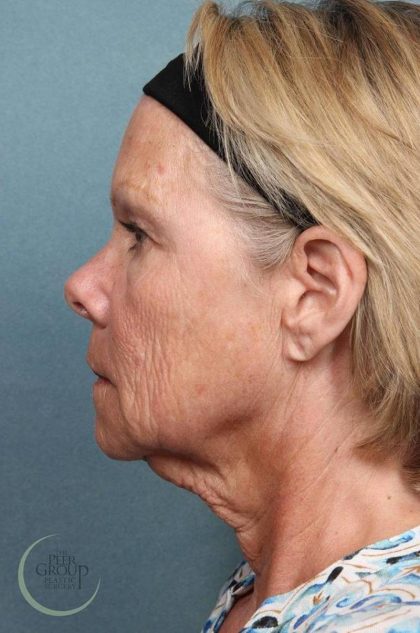 Facelift Before & After Patient #9196