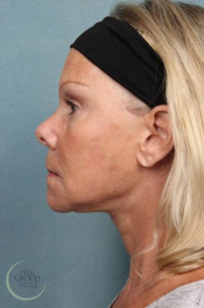 Facelift Before & After Patient #9196