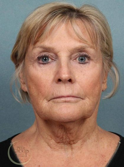Facelift Before & After Patient #9197