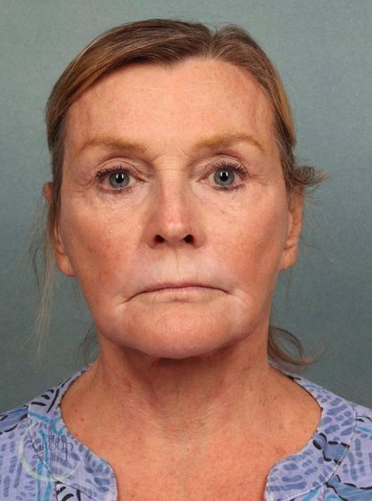 Facelift Before & After Patient #9197
