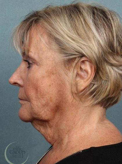 Facelift Before & After Patient #9197