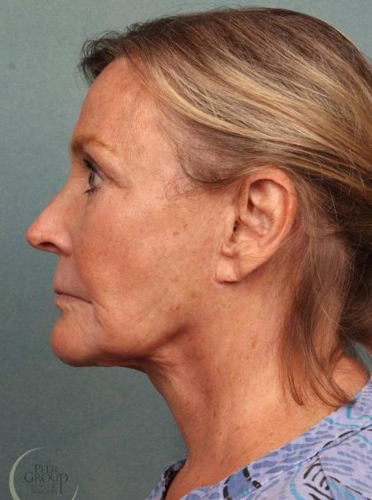 Facelift Before & After Patient #9197