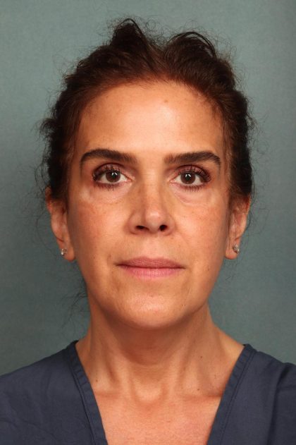Facelift Before & After Patient #9158