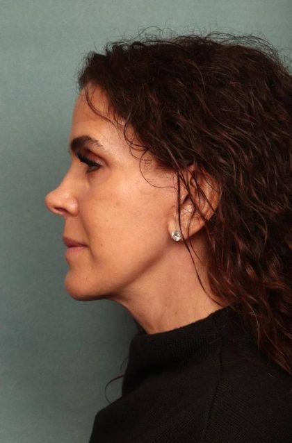 Facelift Before & After Patient #9158