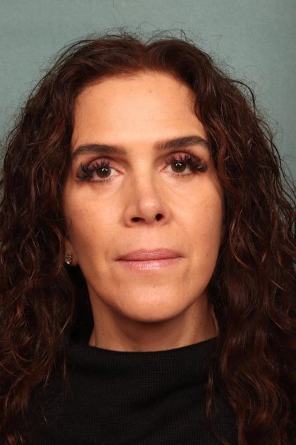 Facelift Before & After Patient #9158