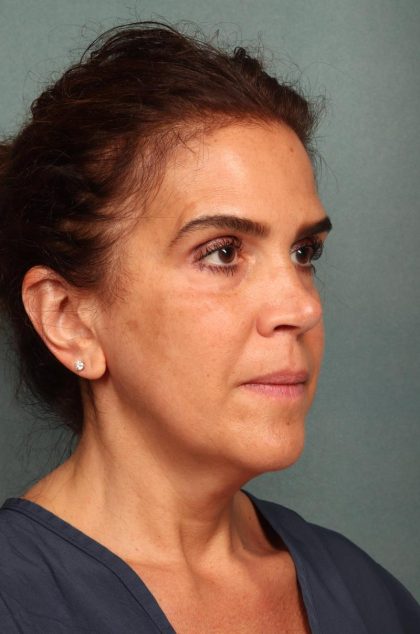 Facelift Before & After Patient #9158