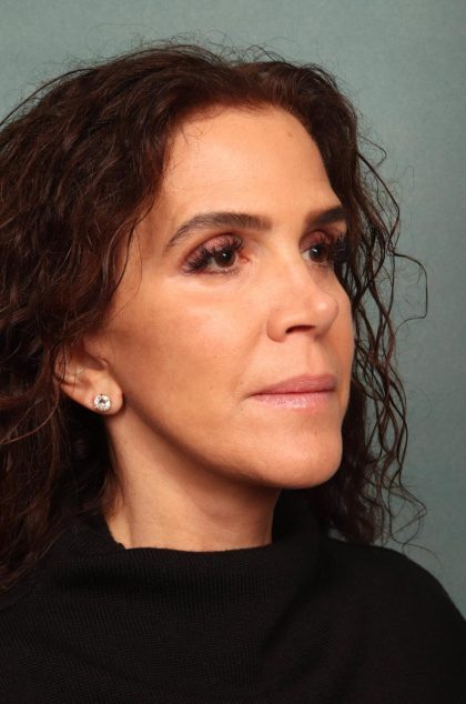 Facelift Before & After Patient #9158