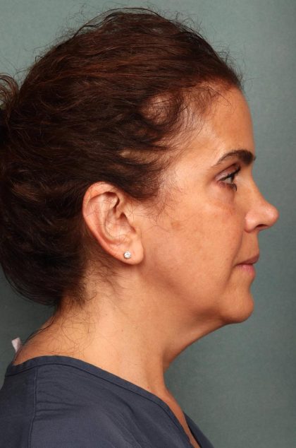 Facelift Before & After Patient #9158