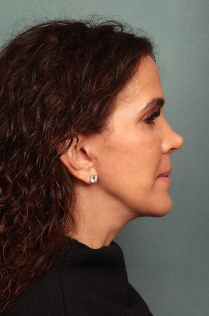 Facelift Before & After Patient #9158