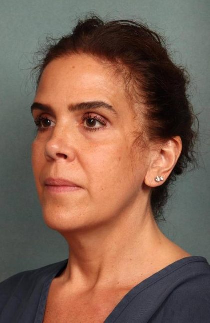 Facelift Before & After Patient #9158