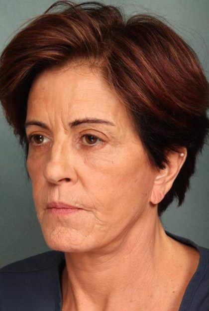 Facelift Before & After Patient #9159