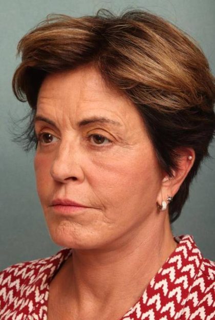 Facelift Before & After Patient #9159