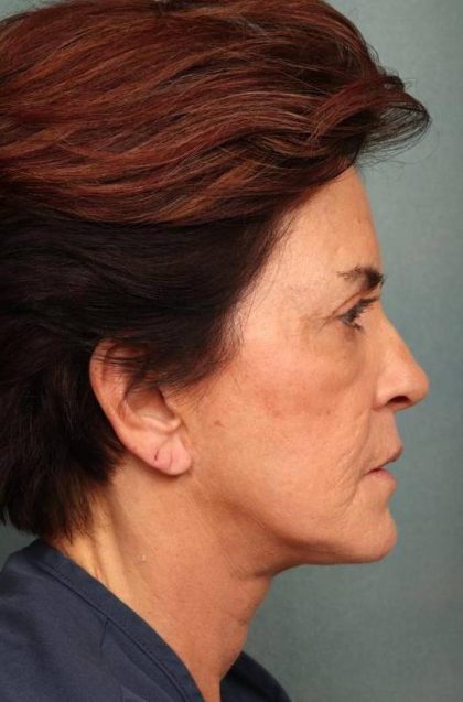Facelift Before & After Patient #9159