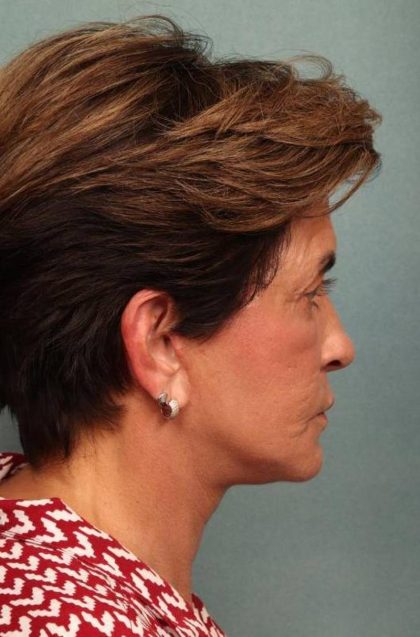 Facelift Before & After Patient #9159