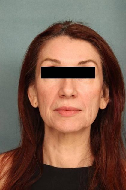 Facelift Before & After Patient #9160