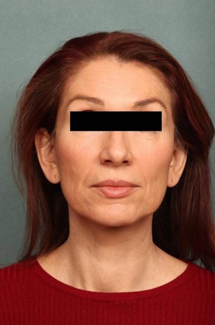 Facelift Before & After Patient #9160