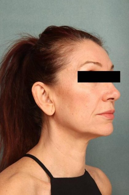 Facelift Before & After Patient #9160