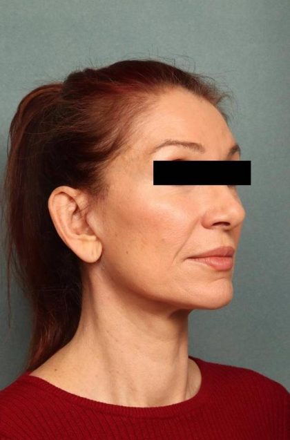 Facelift Before & After Patient #9160