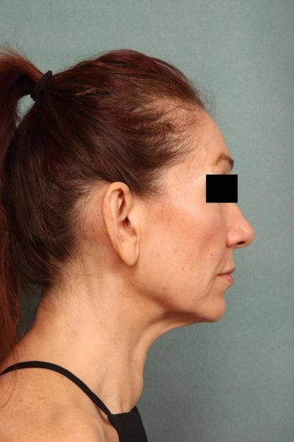 Facelift Before & After Patient #9160