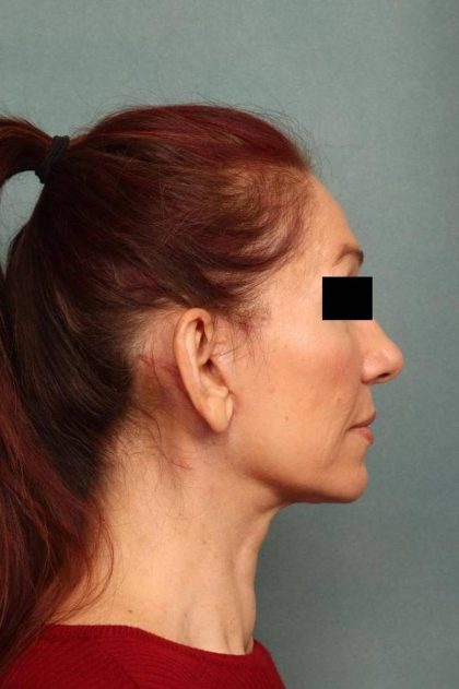 Facelift Before & After Patient #9160