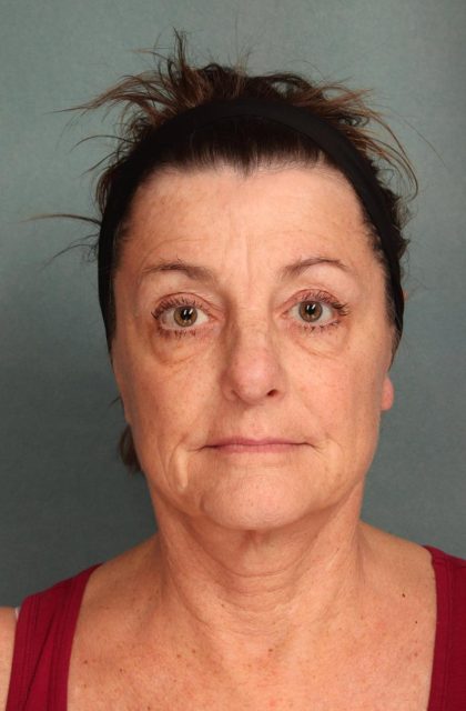 Facelift Before & After Patient #9161