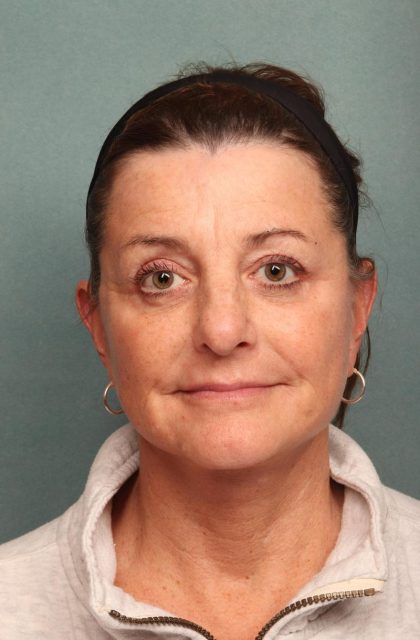 Facelift Before & After Patient #9161