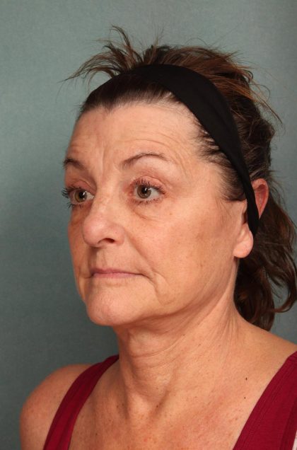 Facelift Before & After Patient #9161