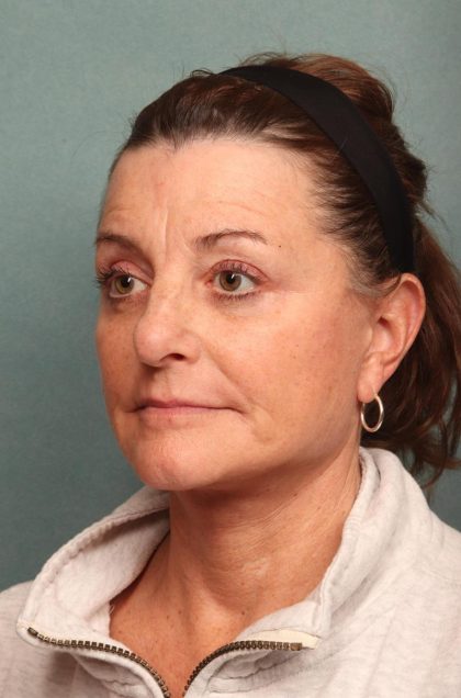 Facelift Before & After Patient #9161