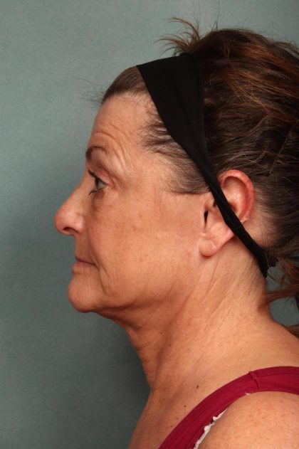 Facelift Before & After Patient #9161