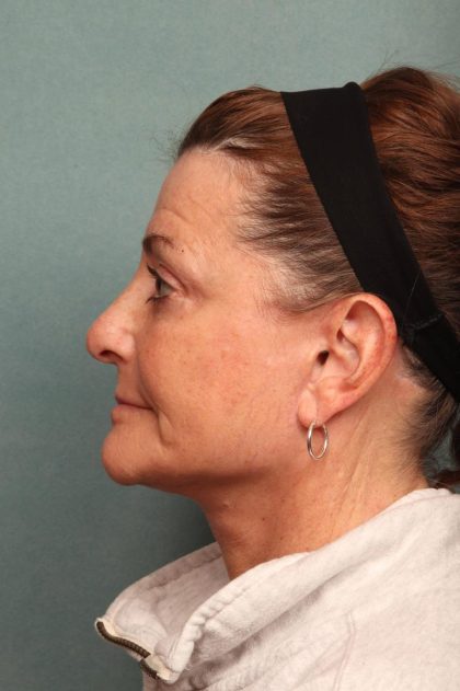 Facelift Before & After Patient #9161