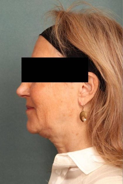 Facelift Before & After Patient #9178