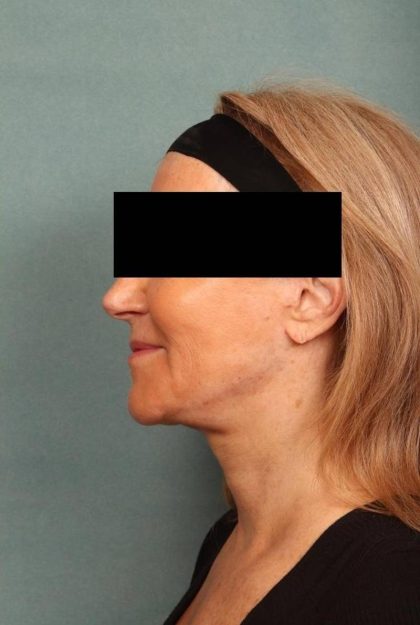 Facelift Before & After Patient #9178