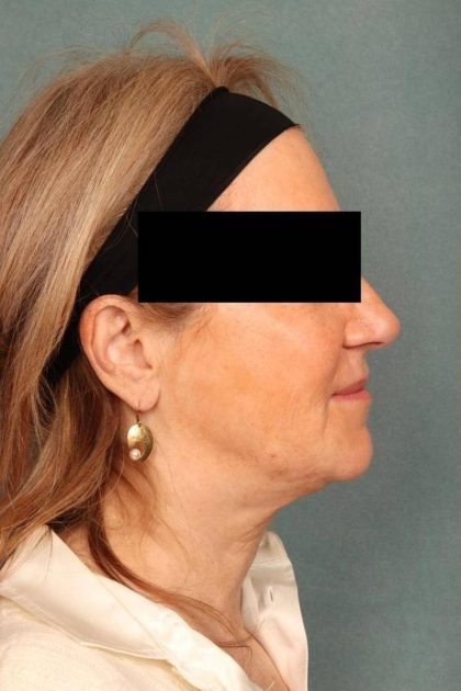 Facelift Before & After Patient #9178