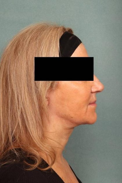 Facelift Before & After Patient #9178