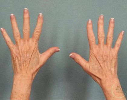 Fat Transfer Body Before & After Patient #9176